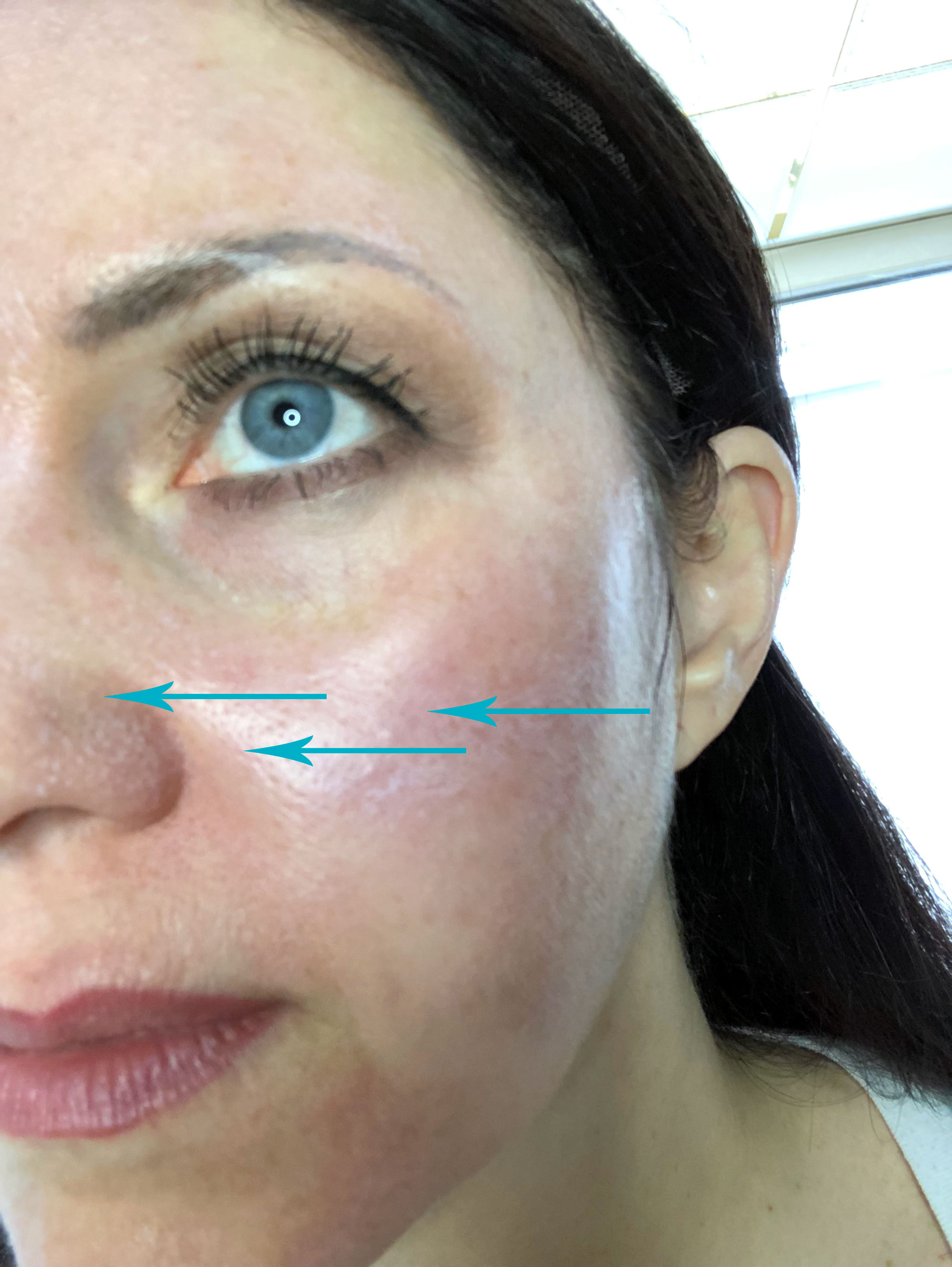 What is frosting? Platinum Skin Care